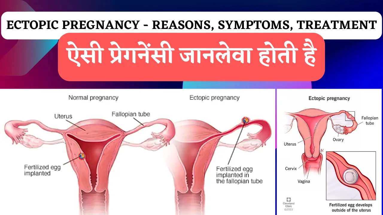 ectopic-pregnancy-in-hindi-3-reasons-and-8-important-symptoms